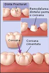 Coroane dentare - remodelare dinte fracturat