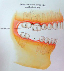 dinte_lipsa_1