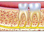 extractie-regenerare_3