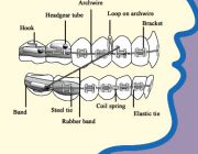 Aparate dentare: Aparat Ortodontioc Metalic