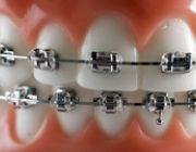 Aparate dentare: Aparat Ortodontioc Metalic
