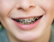 Aparate dentare: Aparat Ortodontioc Metalic