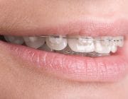 Aparate dentare: Aparate dentare ceramice