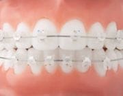 Aparate dentare: Aparate dentare ceramice