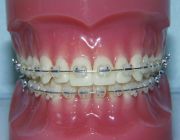 Aparate dentare: Aparate dentare ceramice