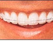 Aparate dentare: Aparate dentare ceramice