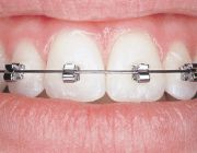 Aparate dentare: Apartare ortodontice Speed