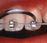 Aparate dentare: Apartare ortodontice Speed