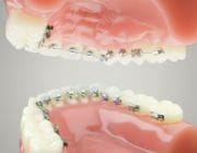 Aparate dentare: Aparatul ortodontic lingual (Incognito)