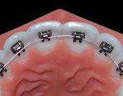 Aparate dentare: Aparatul ortodontic lingual (Incognito)