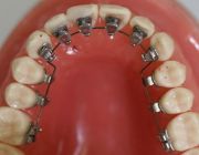 Aparate dentare: Aparatul ortodontic lingual (Incognito)