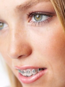 Aparate Dentare: Cand se recomanda