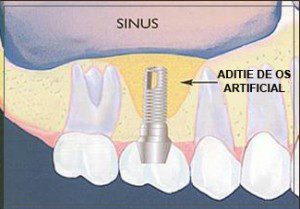 sinus-aditie-os-artificial