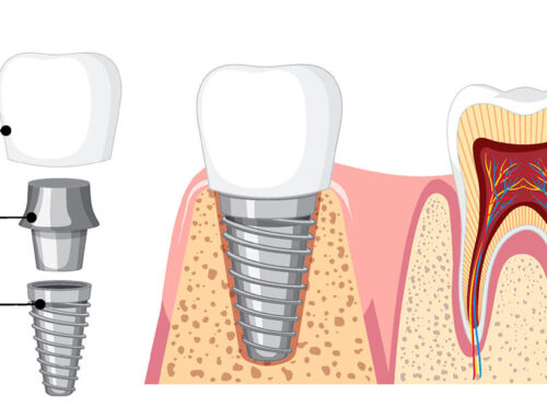 Implant dentar. Ce este si la ce ma ajuta?